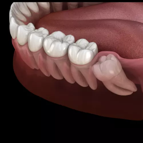 Cirurgia oral menor